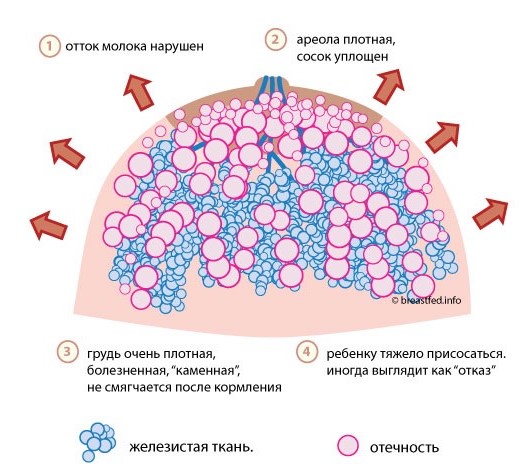 Боли и нагрубание молочных желез