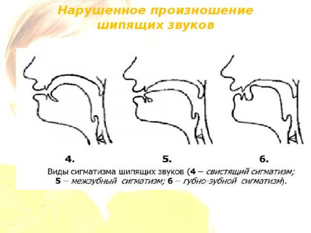 Расстройство артикуляции. Нарисуйте профили артикуляции свистящих звуко. Артикуляционный профиль звуков при ринолалии. Профили артикуляции свистящих звуков. Нарушение произношения свистящих звуков.