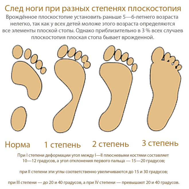 Во сколько детей ставят на ножки. Отпечаток стопы 3 степени плоскостопия. Степени развития плоскостопия. Отпечаток здоровой стопы и с плоскостопием. Плоскостопие отпечаток стопы степени.