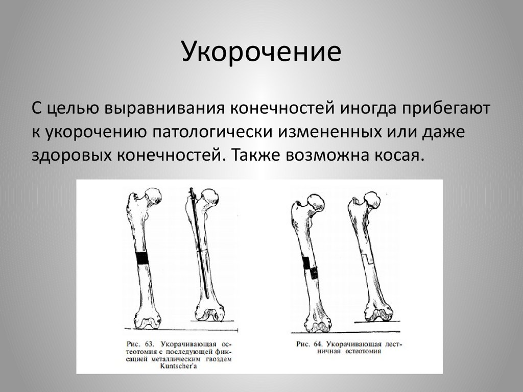 Укорочение нижней конечности код по мкб 10