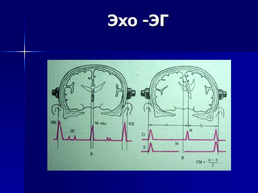 Какой эхо. ЭХОЭГ эхоэнцефалография. М Эхо мозга. Эхоэнцефалография расшифровка. ЭХОЭГ – эхоэнцефалография расшифровка.
