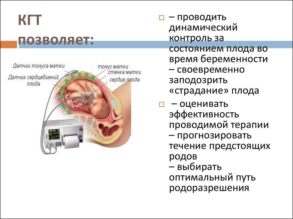 Тонус матки при беременности симптомы. КГТ плода при беременности что это такое. Внутренняя КТГ.