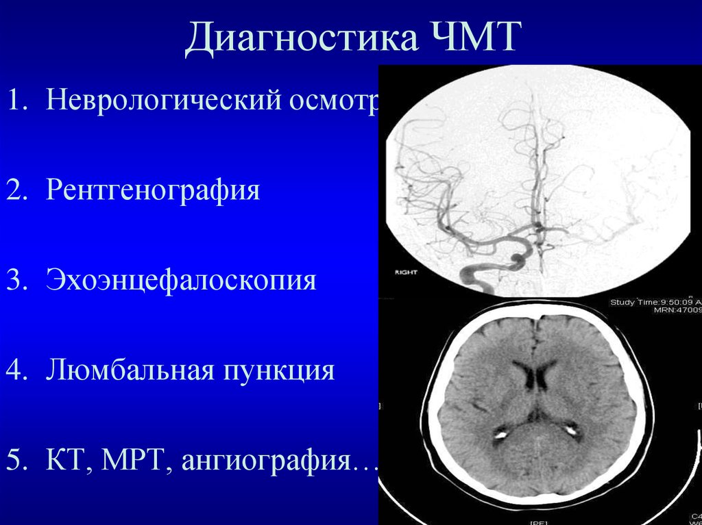 Закрытая черепно мозг травма. Диагностика при ЧМТ. Черепно-мозговая травма методы исследования. Алгоритм диагностики ЧМТ.