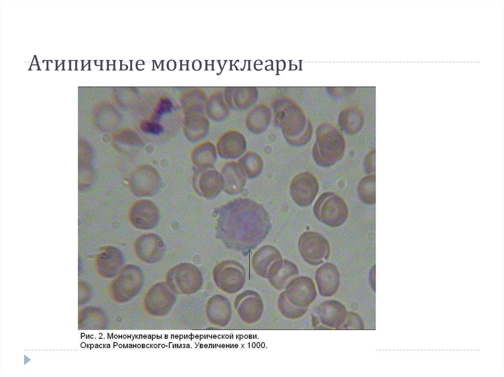 Атипичные мононуклеары. Мононуклеары микроскопия крови. Мононуклеары периферической крови. Атипичные мононуклеары микроскопия. Атипичные мононуклеары клетки в мазке крови.