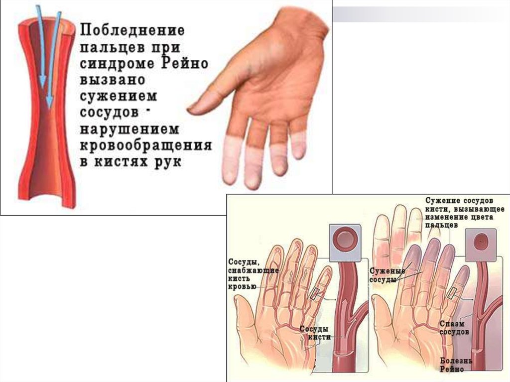 Почему немеют пальцы что делать. Синдром Рейно кисти рук. Синдром запястного канала и синдром Рейно. УЗИ артерий верхних конечностей при синдроме Рейно.