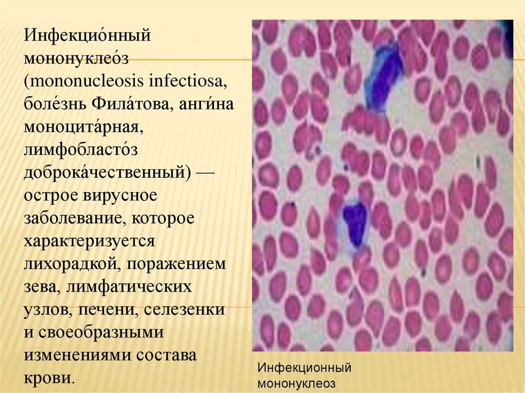 Моноклеоз. Инфекционный мононуклеоз мазок крови. Инфекционный мононуклеоз в мазке крови. Инфекционный мононуклеоз картина крови. Мононуклеоз у детей картина крови.