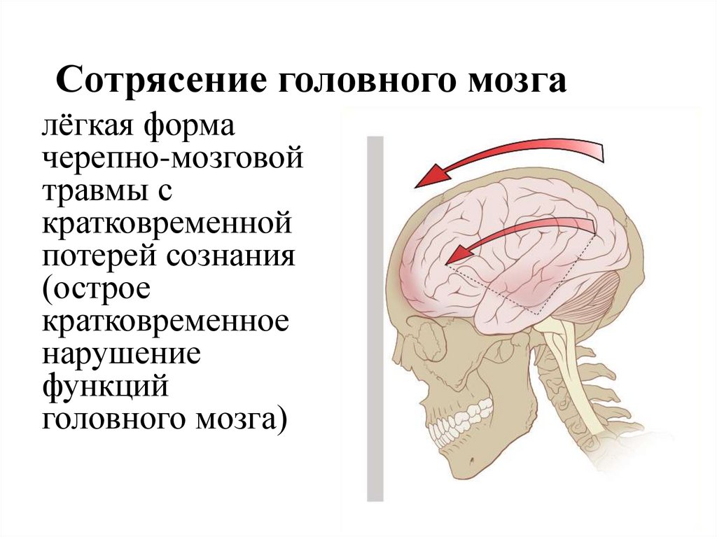 Сотрясение мозга что делать