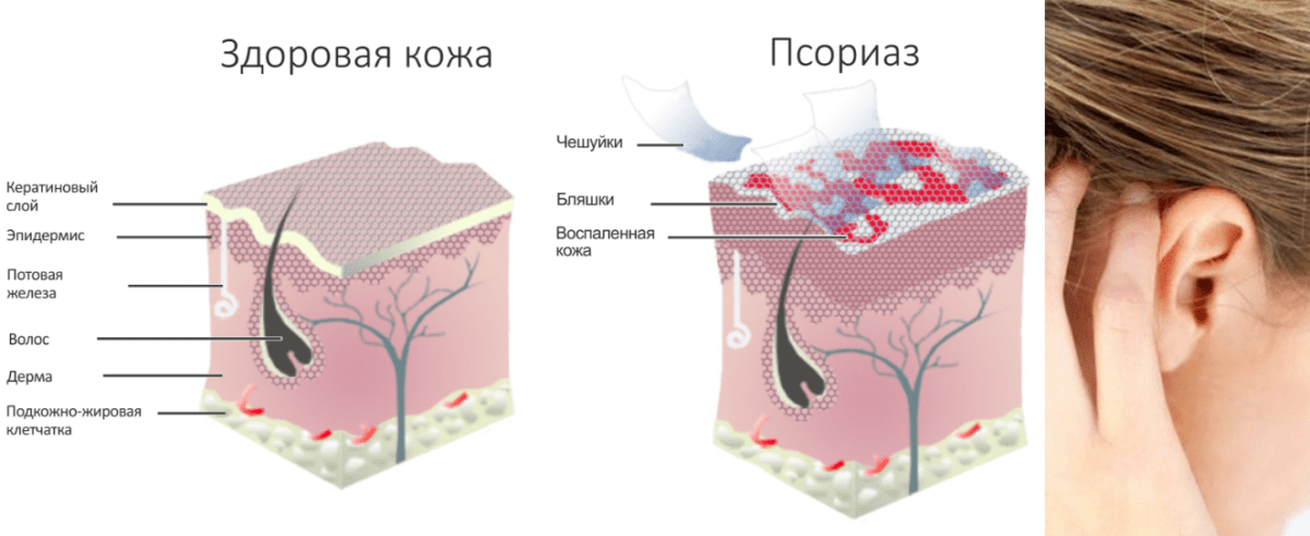 Почему чешется внутри. Себорейный дерматит за ушами.