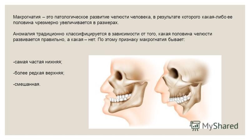 Почему сжата челюсть. Микрогнатия верхней челюсти (гипоплазия верхней челюсти. Макрогнатия и микрогнатия. Макрогнатия нижней челюсти. Чрезмерно развитая верхняя челюсть.