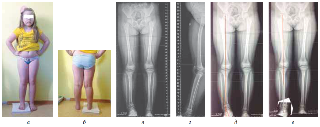 Кости ног ребенка. Варусная деформация голени рентген. Варусная деформация нижних конечностей рентген. Варусная деформация рентген. Варусная деформация большеберцовой кости.