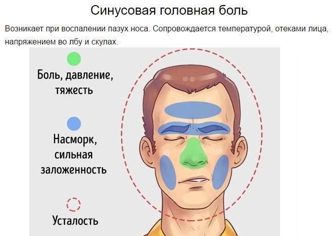 Симптомы насморк головная боль. Синусовая головная боль. Синусная головная боль. Синусовая боль головы.