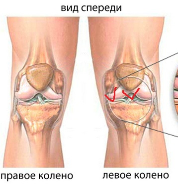 Болит чашка колена. Опухоль внутри сбоку коленного сустава. Припухлость левого коленного сустава.