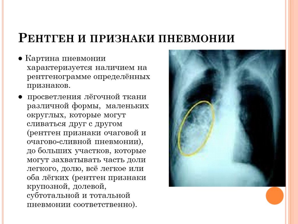 Клиническая картина пневмония у детей