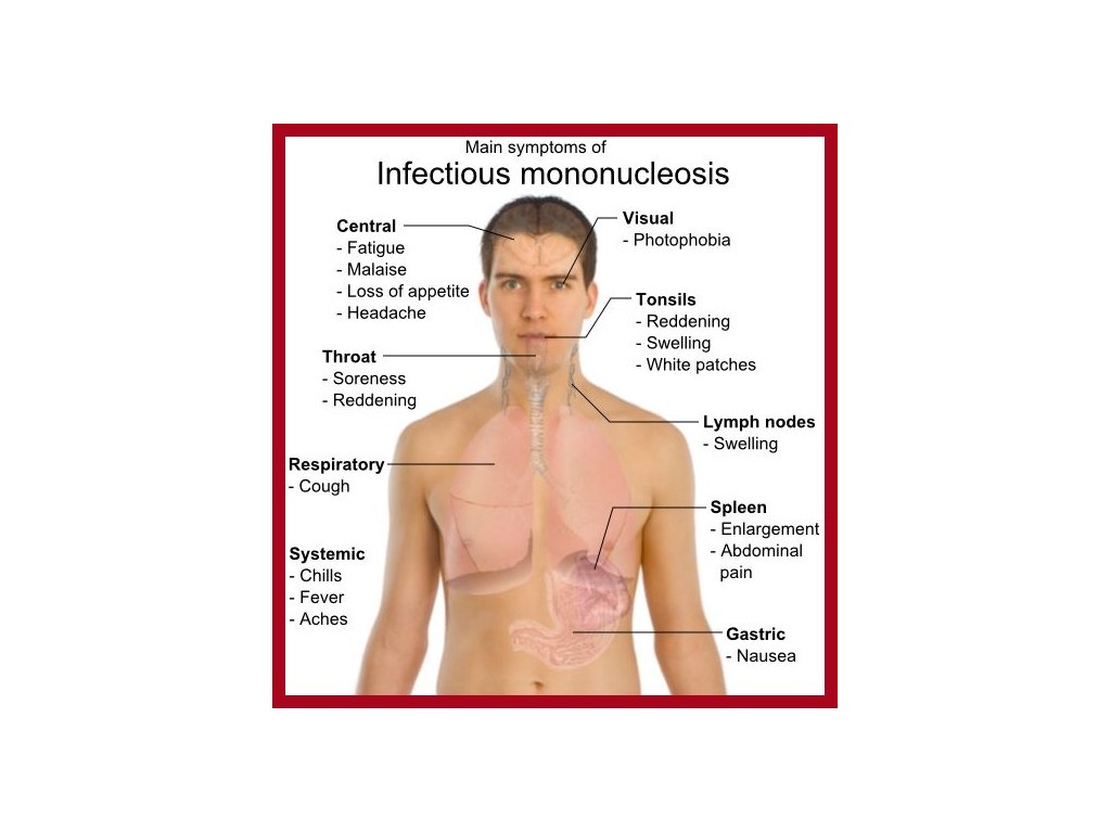 Мононуклеоз это. Сыпь при мононуклеозе причины. Инфекционный мононуклеоз сыпь. Инфекционный мононуклеоз у детей клинические рекомендации. Внешний вид больного мононуклеозом.