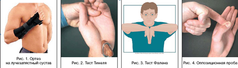 Синдромом операция. Туннельный синдром запястья кисти. Блокада карпального туннельного синдрома. Симптомы туннельного синдрома запястного канала. Туннельный синдром лучезапястного сустава.