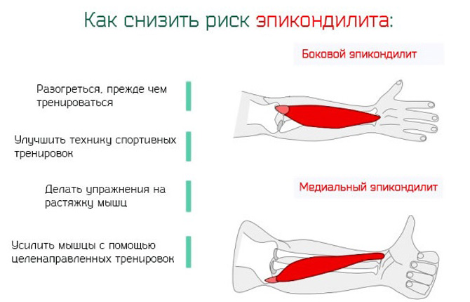 Ноет локоть причины. Эпикондилит локтевого симптомы. Медиальный эпикондилит упражнения. Эпикондилит локтевого упражнения. Эпикондилит локтевого сустава ЛФК.