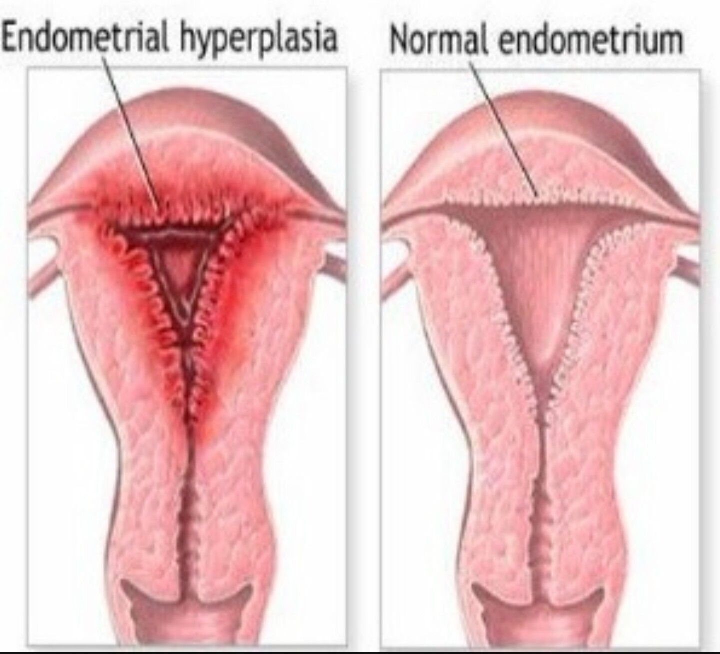 Эндометриоз и гиперплазия